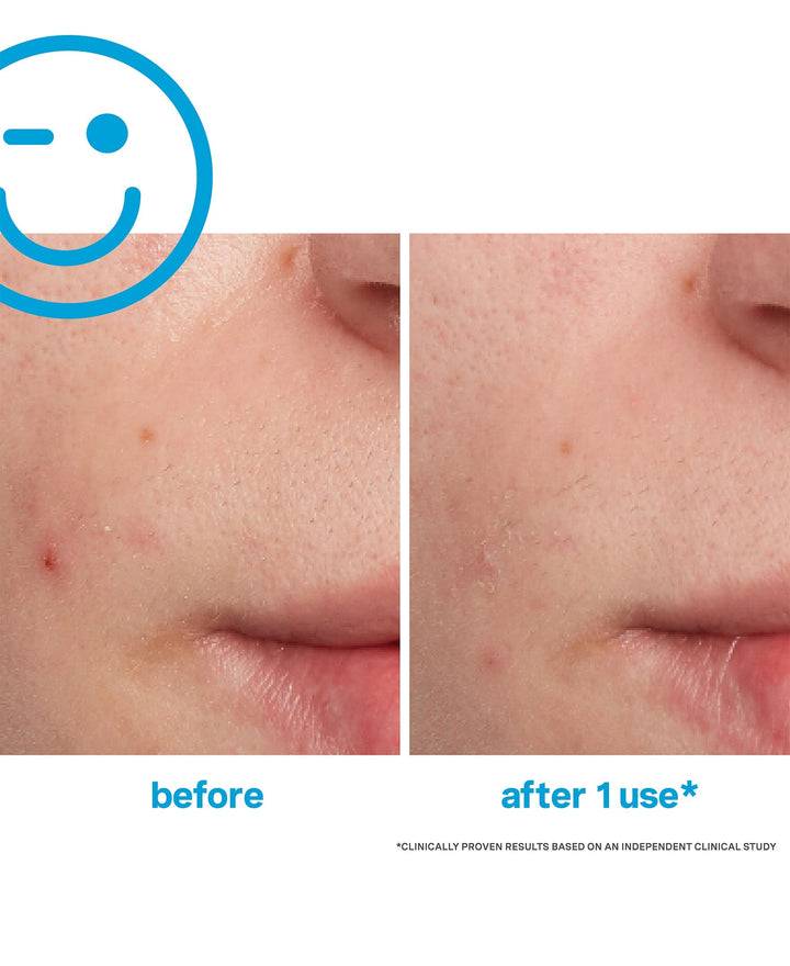 Kate Somerville EradiKate Acne Treatment 30ml Spot Treatment
