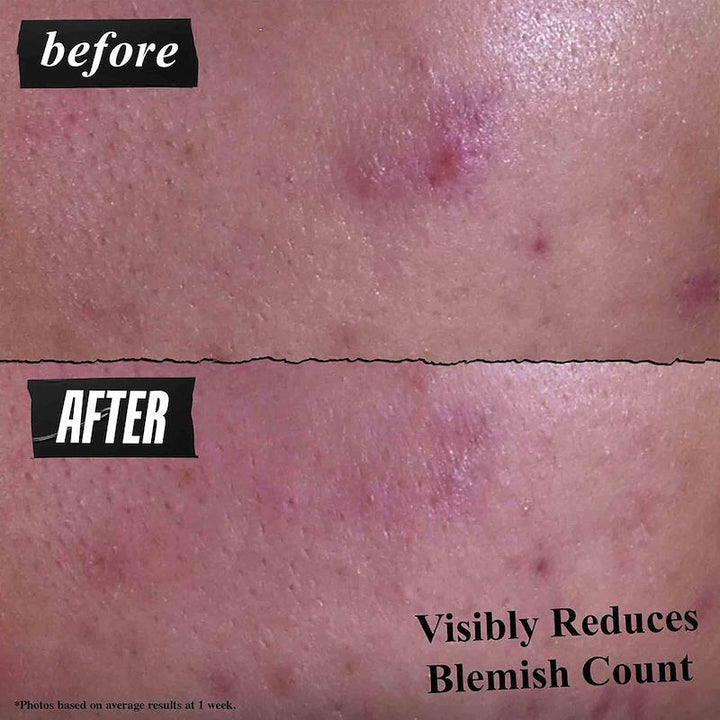 Kiehl's Acne Cleanser 125ml 3-in-1 Blemish Treatment