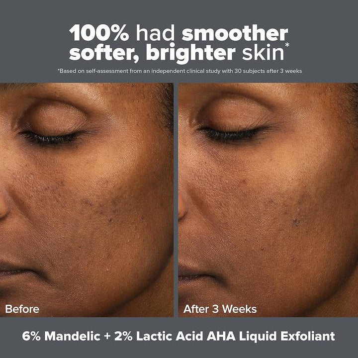 Paula's Choice Skin Perfecting 6% Mandelic 2% Lactic Liquid Exfoliant